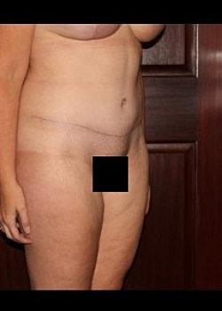 Long Island Plastic Surgical Group tummy tuck after — Garden City, NY