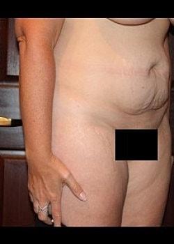Mini Tummy Tuck before at Long Island Plastic Surgical Group in Garden City, NY