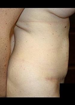 Long Island Plastic Surgical Group tummy tuck after — Garden City, NY