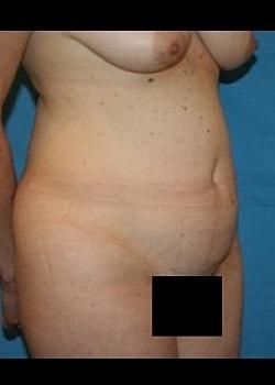 Mini Tummy Tuck before at Long Island Plastic Surgical Group in Garden City, NY