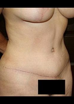 Long Island Plastic Surgical Group tummy tuck after — Garden City, NY