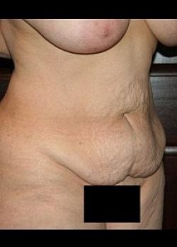 Mini Tummy Tuck before at Long Island Plastic Surgical Group in Garden City, NY