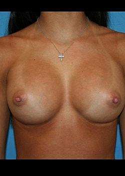 Long Island Plastic Surgical Group breast augmentation after — Garden City, NY