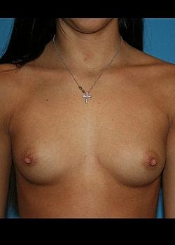 Fat Transfer Breast Augmentation before at Long Island Plastic Surgical Group in Garden City, NY