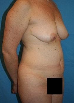 Mommy Makeover before at Long Island Plastic Surgical Group in Garden City, NY