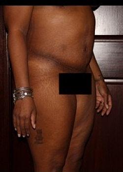 Long Island Plastic Surgical Group tummy tuck after — Garden City, NY