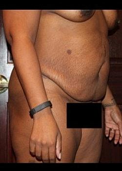Mini Tummy Tuck before at Long Island Plastic Surgical Group in Garden City, NY