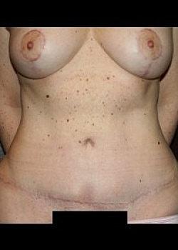Long Island Plastic Surgical Group tummy tuck after — Garden City, NY