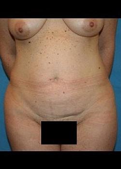 Mini Tummy Tuck before at Long Island Plastic Surgical Group in Garden City, NY