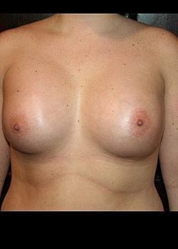Long Island Plastic Surgical Group breast augmentation after — Garden City, NY