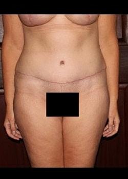 Long Island Plastic Surgical Group tummy tuck after — Garden City, NY