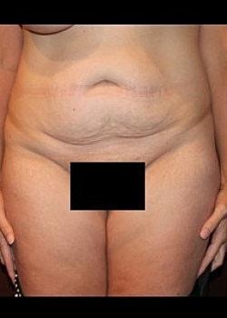 Mini Tummy Tuck before at Long Island Plastic Surgical Group in Garden City, NY