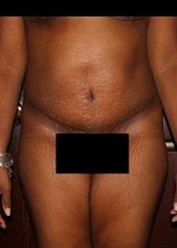 Long Island Plastic Surgical Group tummy tuck after — Garden City, NY