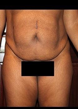 Mini Tummy Tuck before at Long Island Plastic Surgical Group in Garden City, NY