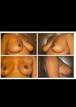 Long Island Plastic Surgical Group breast lift after — Garden City, NY