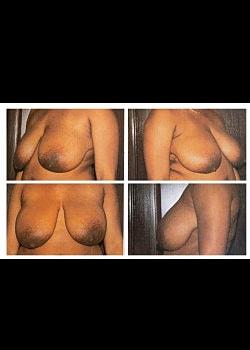 Breast Lift before at Long Island Plastic Surgical Group in Garden City, NY