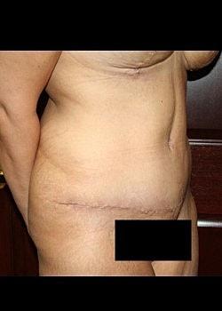 Long Island Plastic Surgical Group tummy tuck after — Garden City, NY