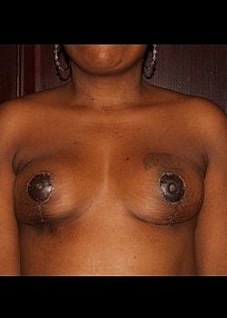 Long Island Plastic Surgical Group breast reduction after — Garden City, NY