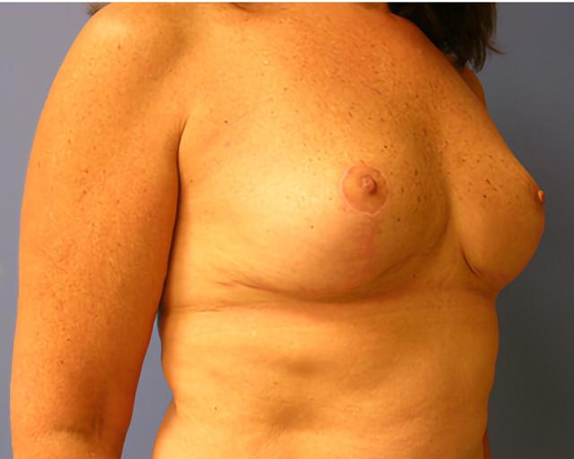Breast Reduction after at Esana Plastic Surgery Center & MedSpa in Guilford, CT