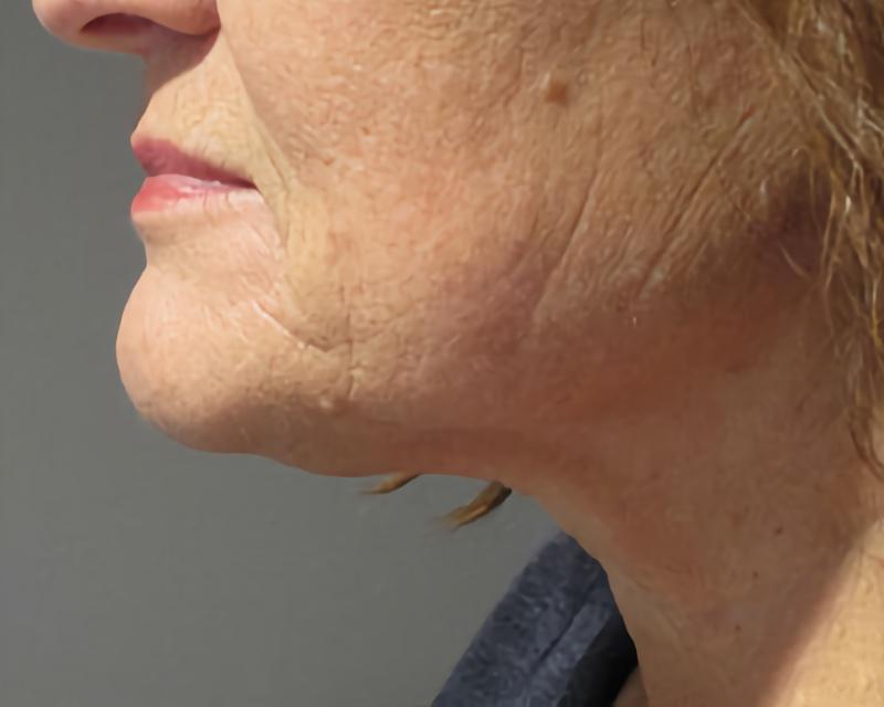 Esana Plastic Surgery Center & MedSpa facelift after — Guilford, CT