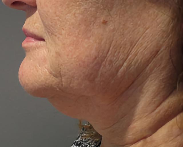 Facelift before at Esana Plastic Surgery Center & MedSpa in Guilford, CT