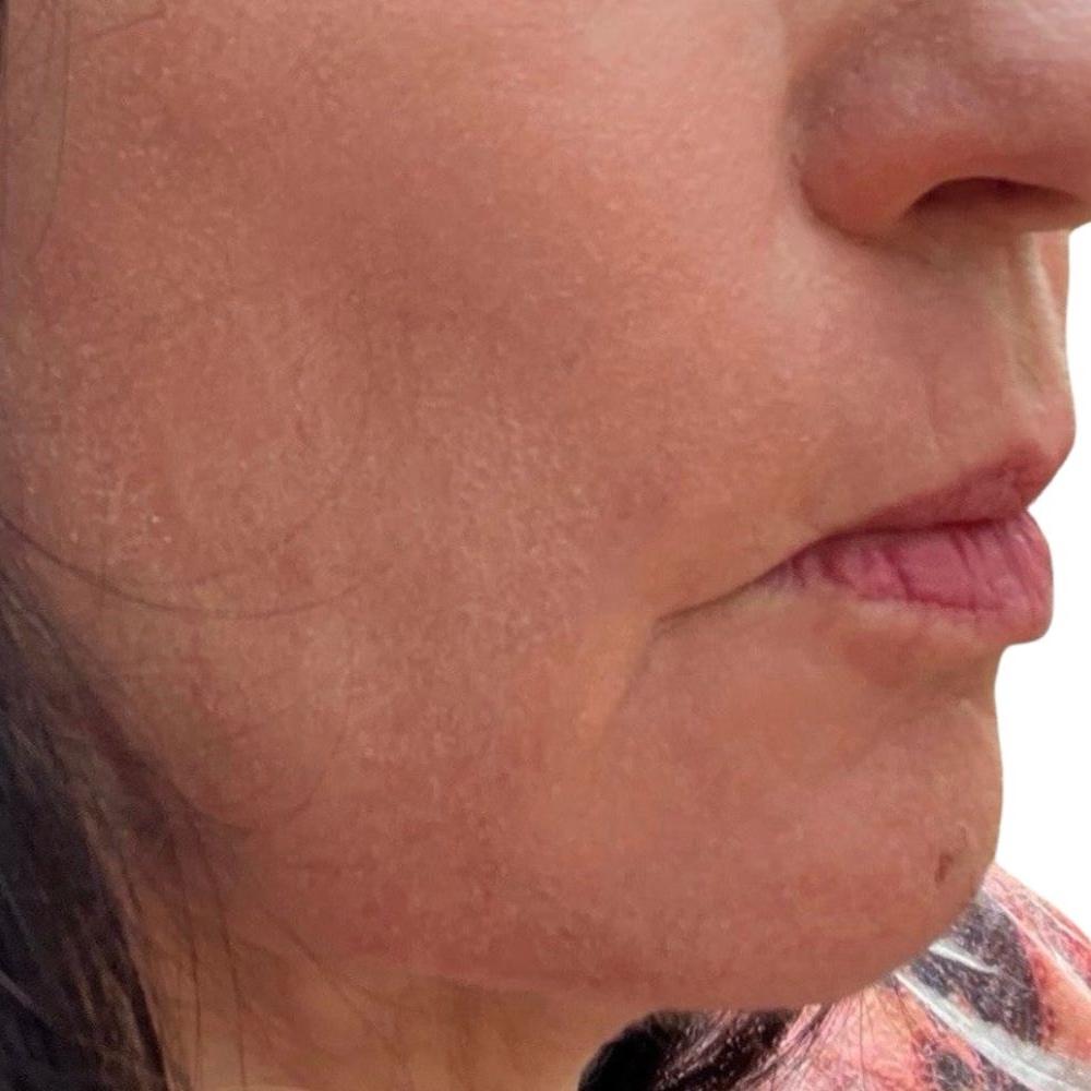 Esana Plastic Surgery Center & MedSpa chemical peel after — Guilford, CT
