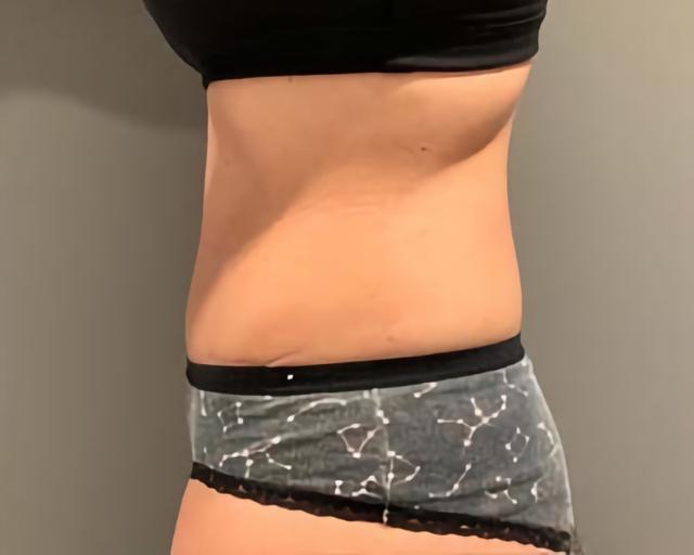 Tummy Tuck after at Esana Plastic Surgery Center & MedSpa in Guilford, CT