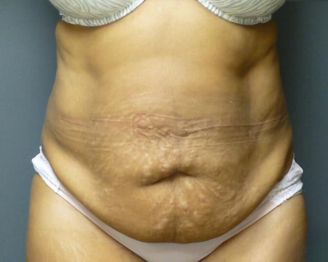 Tummy Tuck before at Esana Plastic Surgery Center & MedSpa in Guilford, CT