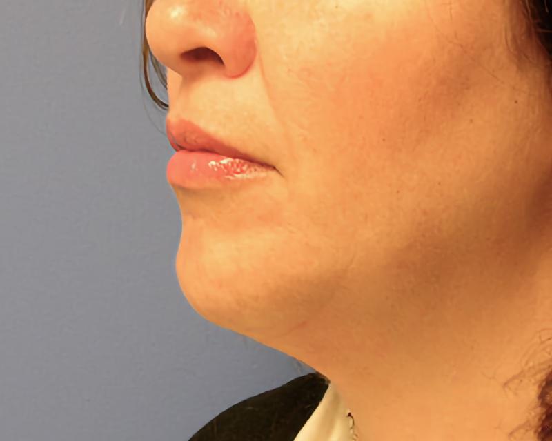 Esana Plastic Surgery Center & MedSpa liposuction after — Guilford, CT
