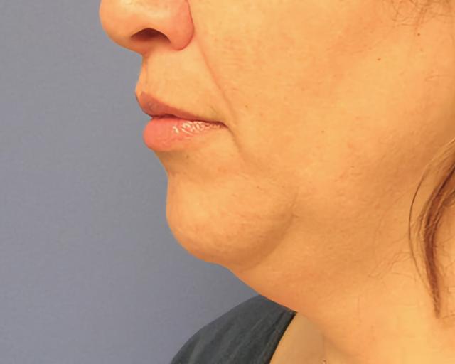 Brazilian Butt Lift before at Esana Plastic Surgery Center & MedSpa in Guilford, CT