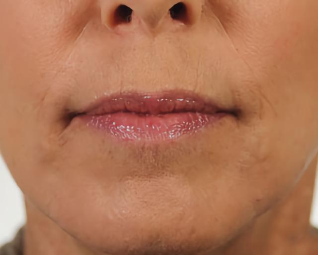 Lip Filler after at Esana Plastic Surgery Center & MedSpa in Guilford, CT