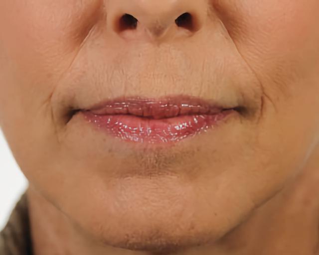 Lip Filler before at Esana Plastic Surgery Center & MedSpa in Guilford, CT