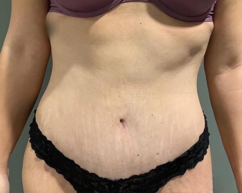 Esana Plastic Surgery Center & MedSpa tummy tuck after — Guilford, CT