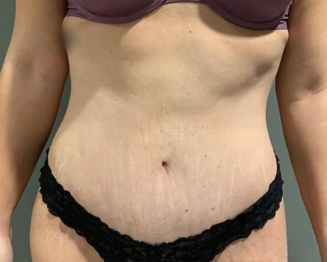 Tummy Tuck after at Esana Plastic Surgery Center & MedSpa in Guilford, CT
