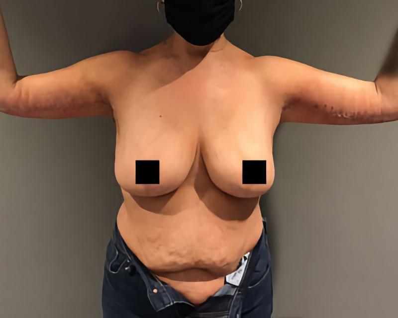 Esana Plastic Surgery Center & MedSpa arm lift after — Guilford, CT