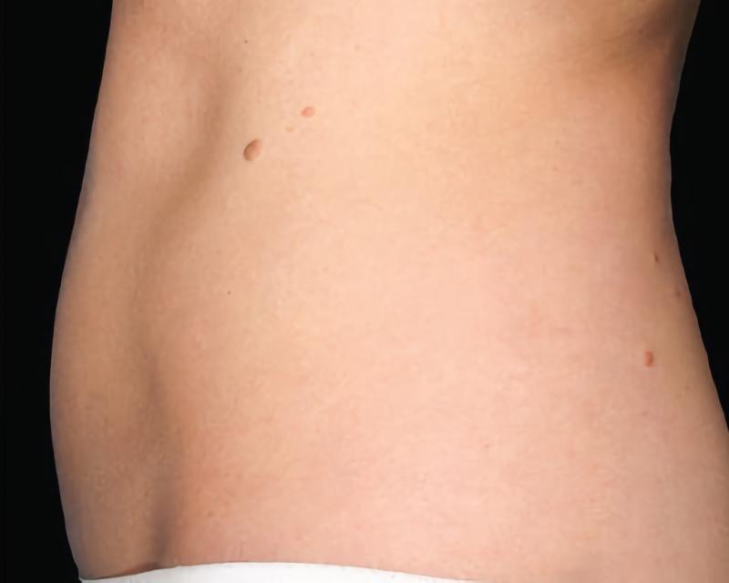 Esana Plastic Surgery Center & MedSpa coolsculpting after — Guilford, CT