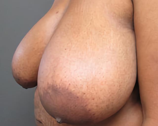 Breast Reduction before at Esana Plastic Surgery Center & MedSpa in Guilford, CT