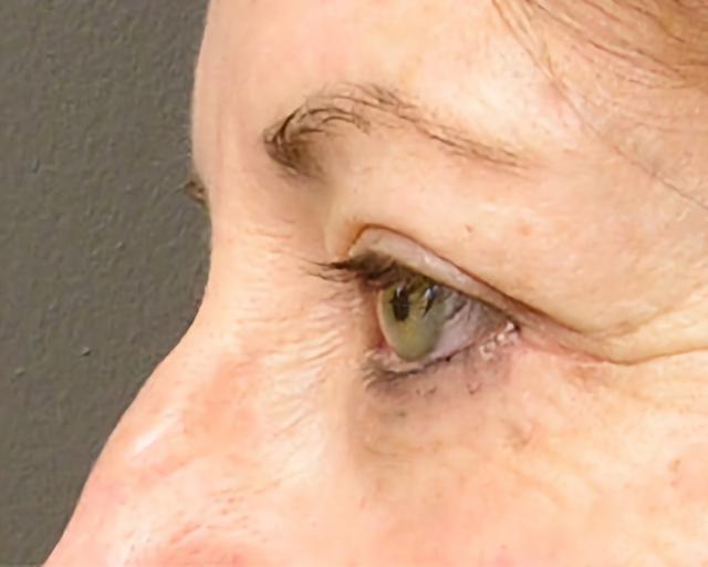 Blepharoplasty after at Esana Plastic Surgery Center & MedSpa in Guilford, CT