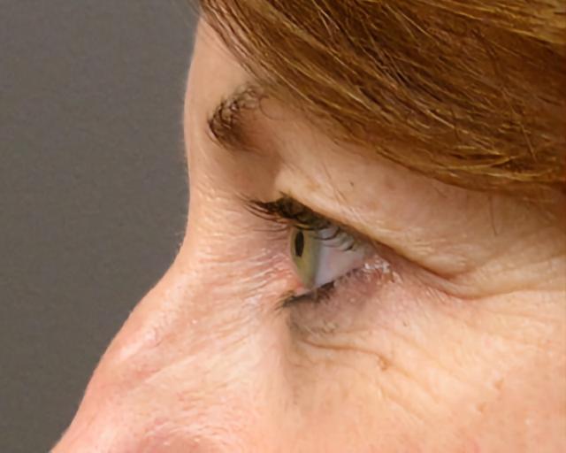 Blepharoplasty before at Esana Plastic Surgery Center & MedSpa in Guilford, CT