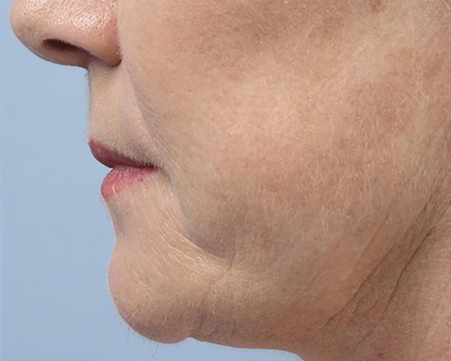 Morpheus8 after at Esana Plastic Surgery Center & MedSpa in Guilford, CT