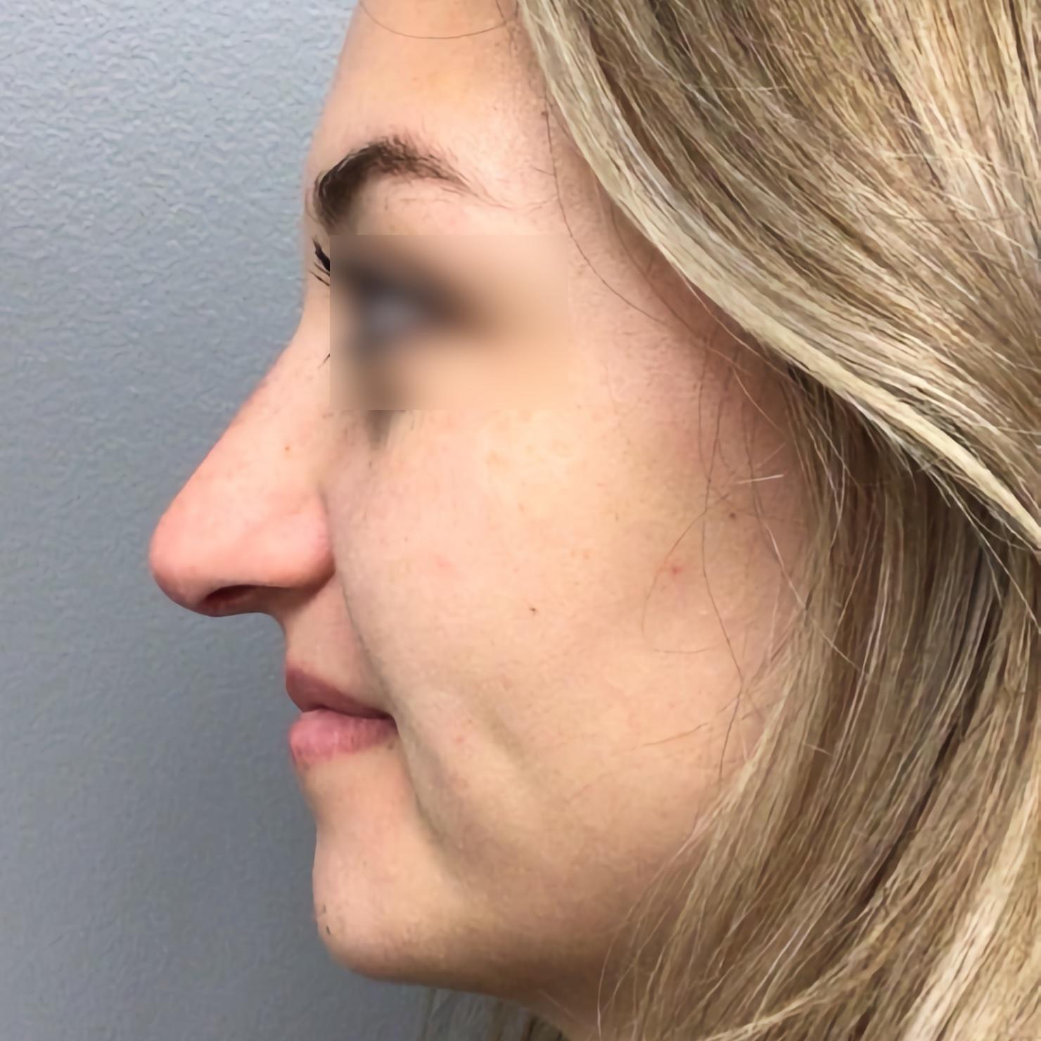 Esana Plastic Surgery Center & MedSpa rhinoplasty after — Guilford, CT