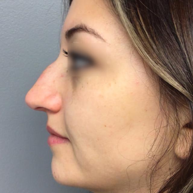Liquid Rhinoplasty before at Esana Plastic Surgery Center & MedSpa in Guilford, CT