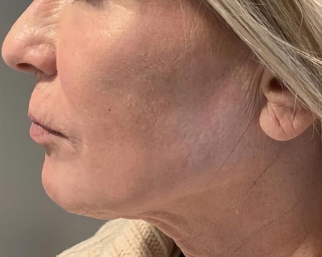 Facelift after at Esana Plastic Surgery Center & MedSpa in Guilford, CT