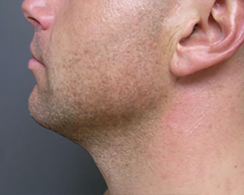 Esana Plastic Surgery Center & MedSpa liposuction after — Guilford, CT