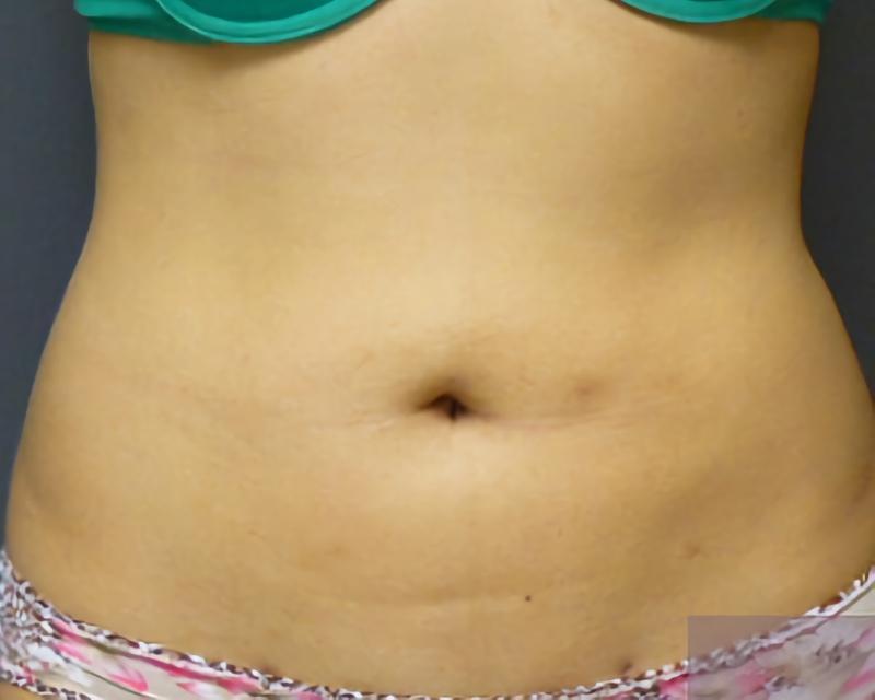 Esana Plastic Surgery Center & MedSpa liposuction after — Guilford, CT