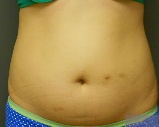 Brazilian Butt Lift before at Esana Plastic Surgery Center & MedSpa in Guilford, CT