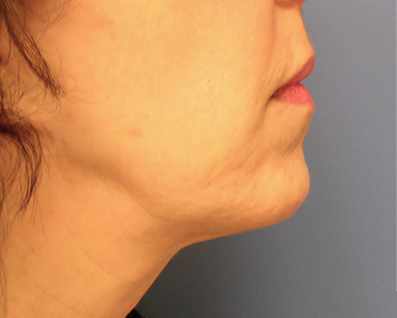 Esana Plastic Surgery Center & MedSpa liposuction after — Guilford, CT