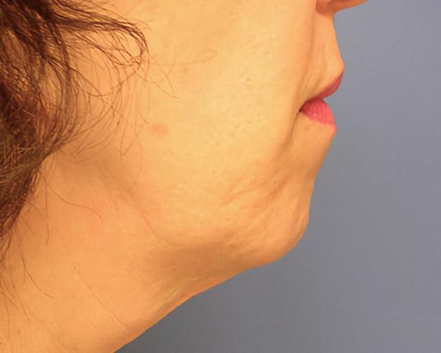 Brazilian Butt Lift before at Esana Plastic Surgery Center & MedSpa in Guilford, CT