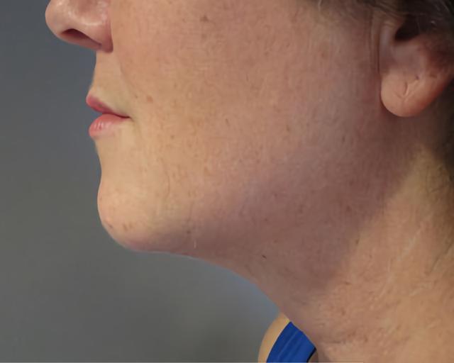 Neck Lift after at Esana Plastic Surgery Center & MedSpa in Guilford, CT