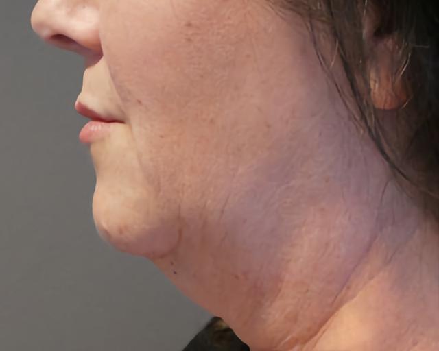 Neck Lift before at Esana Plastic Surgery Center & MedSpa in Guilford, CT